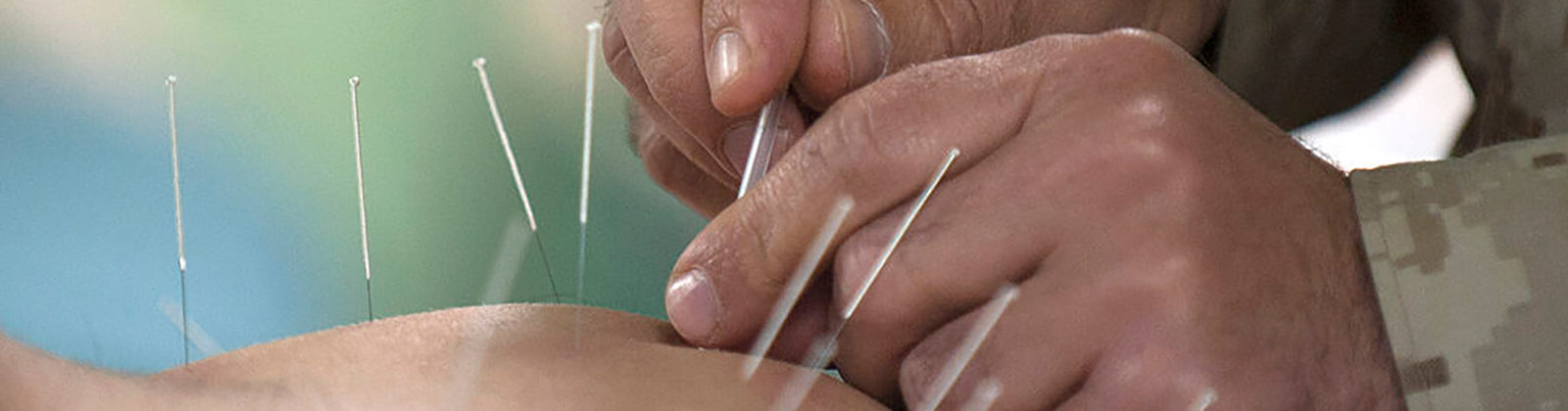 Acupuncture treatment with needles inserted into a patient's back.