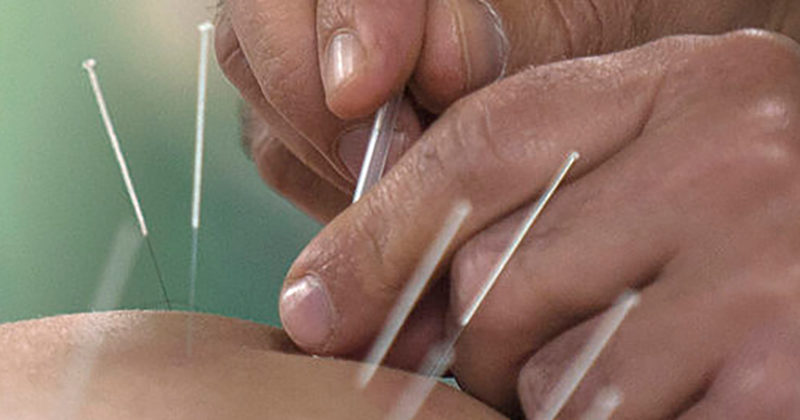 Acupuncture treatment with needles inserted into a patient's back.