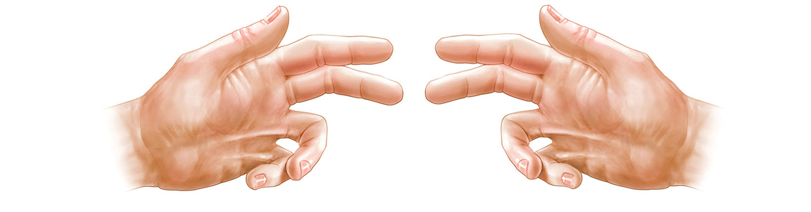 Dupuytren's Contracture in two hands with contracting fingers.