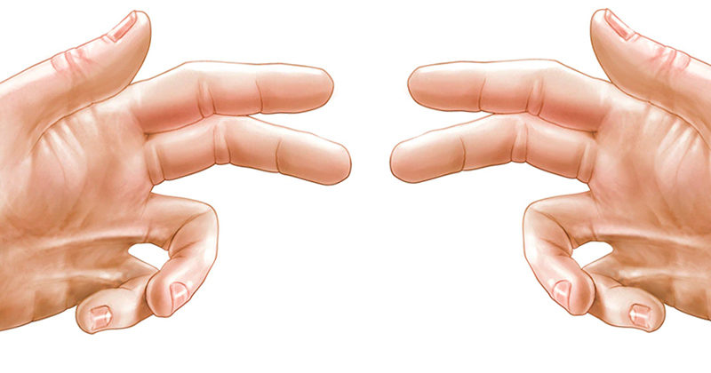 Dupuytren's Contracture in two hands with contracting fingers.