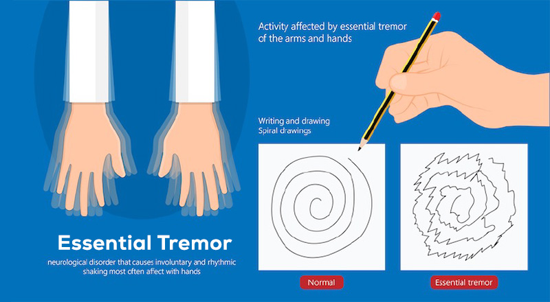 Signs of Essential Tremors can be treated with cannabis
